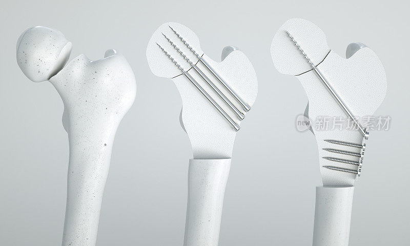 股骨骨折-螺钉治疗- 3D